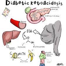 Diabetic Ketoacidosis | Med Supply US