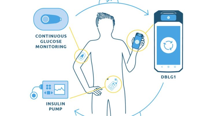 Cgms And Insulin Pump Integration A Perfect Combo Med Supply