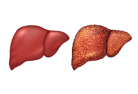 MASLD Patients Face Elevated Risk of Liver-Related Diseases