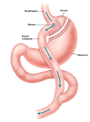 Metabolic Benefits from Gastric Bypass | Med Supply US