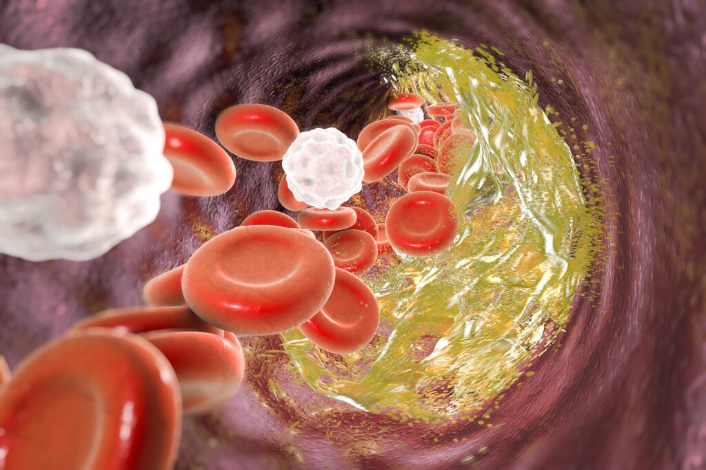 Coronary Atherosclerosis Progression with CGM