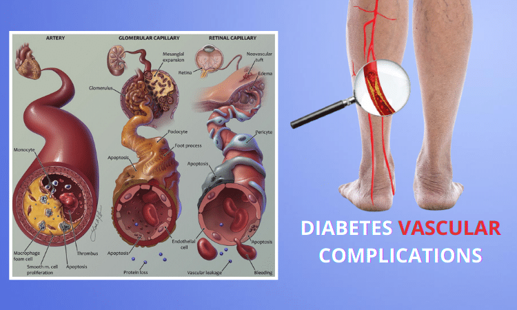 Sugar and the Vascular Complications