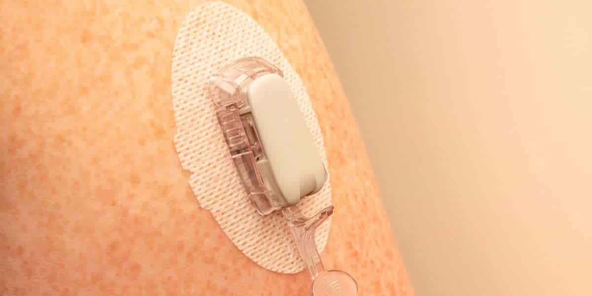 Continuous Glucose Monitors' Proper Insertion Techniques