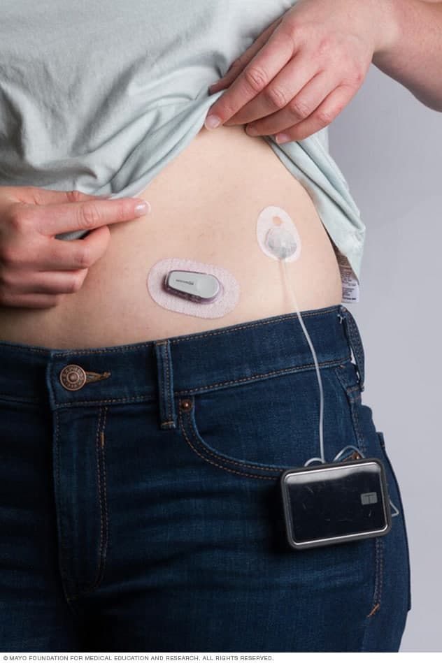 blood sugar monitors